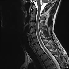 Image Result For Mri Cervical Spine Normal Cuerpo Humano Cuerpo