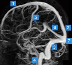 In 1938, fischer published a seminal paper describing five segments of the ica that were designated c1 through c5. Neuroradiology Of The Brain Critical Care Nursing Clinics