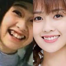 Lulu put on her best smiles / laugh everyday, she has done her perfect tooth  set few yrs back . | Perfect teeth, Good smile, Laugh