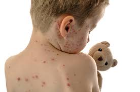 Image result for measles