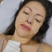 Massoterapia co. Prótese. E retoque de nariz