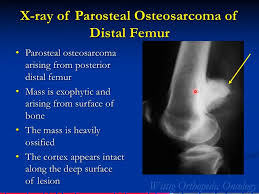 Image result for Osteosarcoma