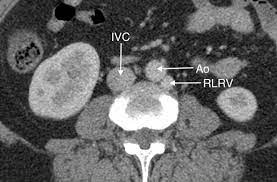 Retroaortic Left Renal Vein Rlrv Draining Into The Left Common Iliac Vein A Rare Variant And Its Clinical Implication Bmj Case Reports
