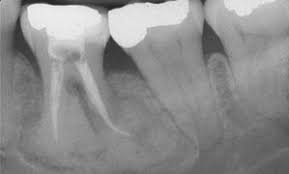 A large nodular, irregular, radiopacity found within a large radiolucent area on the periapical radiograph. Osseous Cemento Osseous Dysplasia Of The Jaws Clinical And Radiographic Analysis Jcda