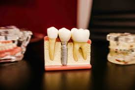 Alpha dental clinic provides a wide range of medical treatments including composite filling, extraction (simple), extraction (surgical or impacted) and more. Ooi Dental Clinic In Ipoh Malaysia Information And Review
