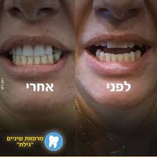 מרפאת שיניים גילת -קרית גת-השתלות שיניים,שיקום הפה,אסתטיקה דנטלית