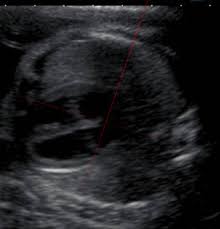 Fetal Heart Ultrasound How To Fetal ultrasound image composite created during exams to screen for spina bifida. fetal heart ultrasound how to