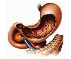 Orice persoana sufera de arsuri stomacale sau aciditate gastrica la un moment dat. Aciditate GastricÄƒ Cauze RecomandÄƒri Remedii Naturiste