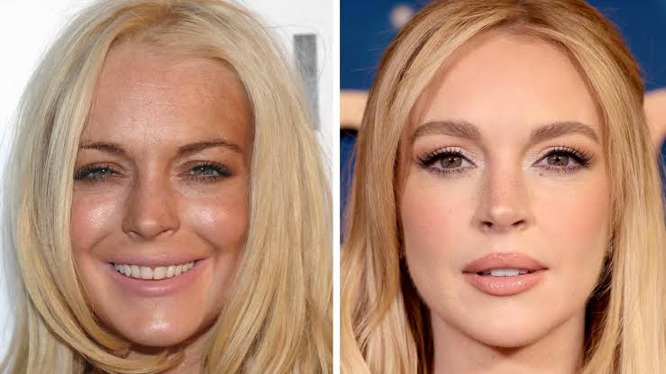 Lindsay Lohan Just Celebrated Her 40th Birthday, Here's What Doctors Have To Say About Her Stunning Transformation