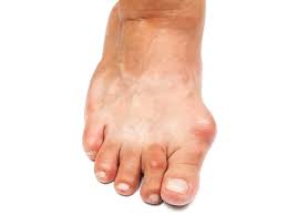 Maybe you would like to learn more about one of these? Bunion Surgery In Iran Procedure Cost Recovery Ariamedtour