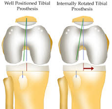 Image result for Patella Tracking Assessment