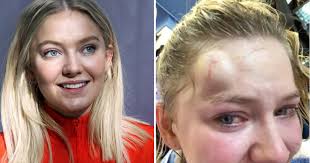 Astrid smeplass (born 29 october 1996) is a norwegian singer and songwriter. Astrid S I Ulykke Astrid S Avlyser Konsert Etter Surfeulykke