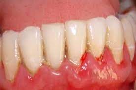 Gum Disease Gum Abscess Periodontal Abscess Pyorrhea And Gingivitis Periodontitis Gingivitis Gum Disease