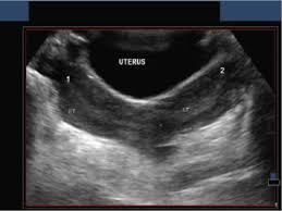 Maybe you would like to learn more about one of these? Ultrasound Of The Pediatric Female Pelvis Semantic Scholar