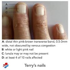 Terry's nails are a type of apparent leukonychia, characterised by ...