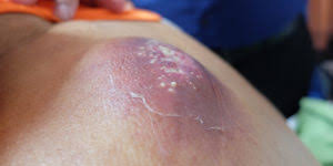 How long do blind pimples last. Blind Pimples On Nose Causes Treatments And Prevention