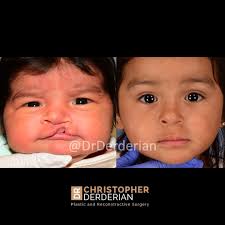 Image result for Cleft Lip