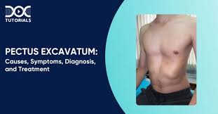 Image result for Pectus Excavatum