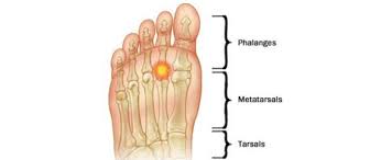 Metatarsalgia centers under the five bones at the bases of the toes, the metatarsals. The Difference Between Mtp Capsulitis Synovitis And Bursitis