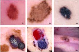 The cancer you're most likely to miss pancreatic cancer is one of the deadliest. An Enhanced Technique Of Skin Cancer Classification Using Deep Convolutional Neural Network With Transfer Learning Models Sciencedirect