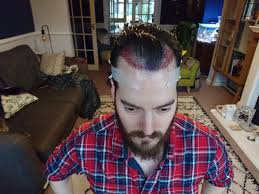 But if you want to solve this problem, you'll need to read an. Pre Workout Hair Loss Reddit Workoutwalls