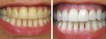 Drinking tea or coffee stains or discolors the dental plaque, but not the teeth itself. Removing Coffee Stains From Teeth Monroe Family Dentistry