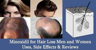 Facial hair growth increased hair loss inflammation or soreness at root of hair reddened skin swelling of face signs and symptoms of too much medicine being absorbed into the body—rare. What Is Minoxidil Does It Help In Beard Growth Is It Safe