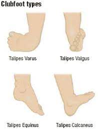 In most cases, clubfoot twists the front of the foot downward and inward, increasing the arch and turning the heel inward. Clubfoot What Is Clubfoot What Causes Clubfoot Who Gets Clubfoot What Are The Symptoms Of Clubfoot