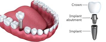 Image result for single tooth implant