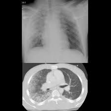 Image result for Pulmonary Contusion