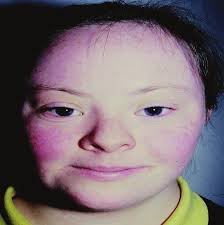 Thyroid Disorder in CYP with Down syndrome: Surveillance and when to  initiate treatment: April 2020 Information update: Down s