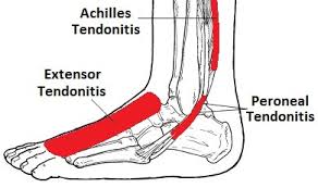 The ankle, or the talocrural region, is the region where the foot and the leg meet. Extensor Tendonitis Treatment In North Texas Graff Foot Ankle And Wound Care