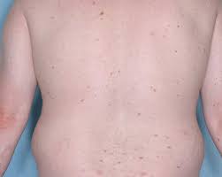 20 mg in the morning and 20 mg in the evening. Plaque Psoriasis Before And After Photos Otezla Apremilast Results