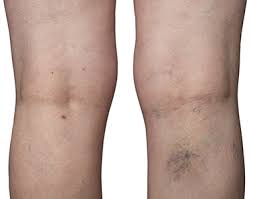 Deep Vein Thrombosis Dr C Raghu Cardiologist