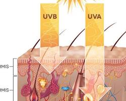 Imagen de Rayos UVB
