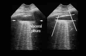 The patient should be comfortable, ideally sitting on the edge of the bed with arms folded forwards and. Lung Ultrasound Lus In Critical Care Diagnostic Approach And Capabilities Esaote