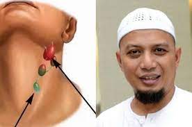 Kanker kelenjar getah bening mengakibatkan kekebalan tubuh menurun. Ustaz Arifin Ilham Meninggal Karena Kanker Getah Bening Ketahui 4 Gejalanya Berikut Ini