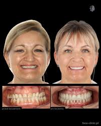 ◾️U Pani Marzeny rozpoznaliśmy wadę szkieletową klasy III (przodozgryz),  zwężenie szczęki i nieprawidłowości zębowe, którym towarzyszyła choroba  przyzębia i braki zębowe. Kompleksowy plan leczenia obejmował leczenie  periodontologiczne, implanto ...