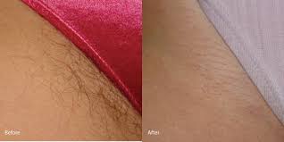 Ingrown hair brazilian laser hair removal before and after photos. My Hair Removal Experience Redondo Beach