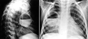 Image result for Lung Abscess