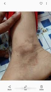 Image result for brown patches on the feet