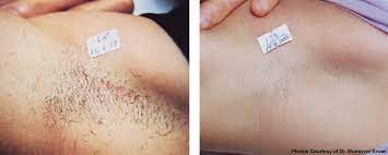 After few days, from 2 days to 1 week, hair appear on skin surface. Permanent Hair Removal Avri Laser Aesthetics
