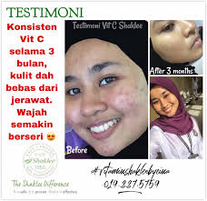 Sape lagi nak vitamin c. Testimoni Vitamin C Atasi Masalah Jerawat Eina Md Ali Pengedar Shaklee Kedai Nutrisi Usj Subang Jaya