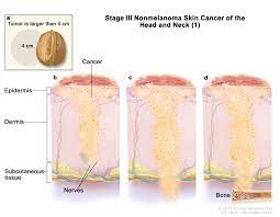 Skin Cancer Types Symptoms Information Dana Farber Cancer Institute Boston Ma