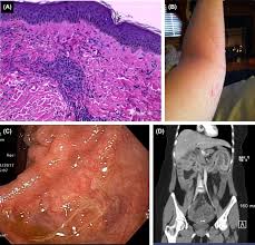 Book an appointment with mr wilson. Rectal Bleeding An Overview Sciencedirect Topics