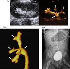 Vesicoureteral reflux (vur) is the retrograde passage of urine from the bladder into the upper urinary tract. Two Dimensional 2d Three Dimensional Static 3d And Real Time 4d Contrast Enhanced Voiding Urosonography Cevus Versus Voiding Cystourethrography Vcug In Children With Vesicoureteral Reflux European Journal Of Radiology