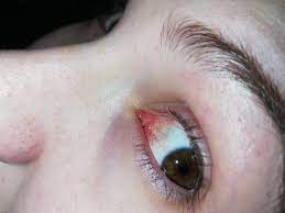 Mein auge ist seitdem ich gestern aufgestanden bin, sprich seit 2 tagen, richtung nase am lied rot (innen wie außen) und ein wenig geschwollen. Komischer Kleiner Gnubell Arzt Augen Knubbel