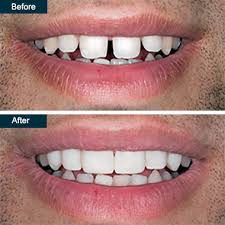 Braverman is one of the leading nyc cosmetic dentist's and has created winning smiles for new york city models, tv and . Before After Top Rated Family Cosmetic Dentist In Yonkers Ny