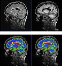Multiple Sklerose Universitatsinstitut Fur Diagnostische Und Interventionelle Neuroradiologie