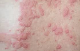 Image result for skin rash acute hiv infection